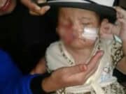 Terlahir Cacat di Bagian Wajah, Bayi Laura Butuh Pertolongan