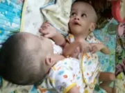 1 Milyar, Bayi Kembar Siam di Tangerang Segera Operasi