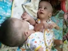 1 Milyar, Bayi Kembar Siam di Tangerang Segera Operasi 1 Milyar, Bayi Kembar Siam di Tangerang Segera Operasi
